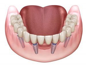 Mandibular prosthesis All on 4 system supported by implants. Medically accurate 3D illustration of human teeth and dentures concept