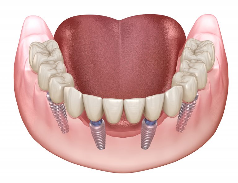 Mandibular prosthesis All on 4 system supported by implants. Medically accurate 3D illustration of human teeth and dentures concept